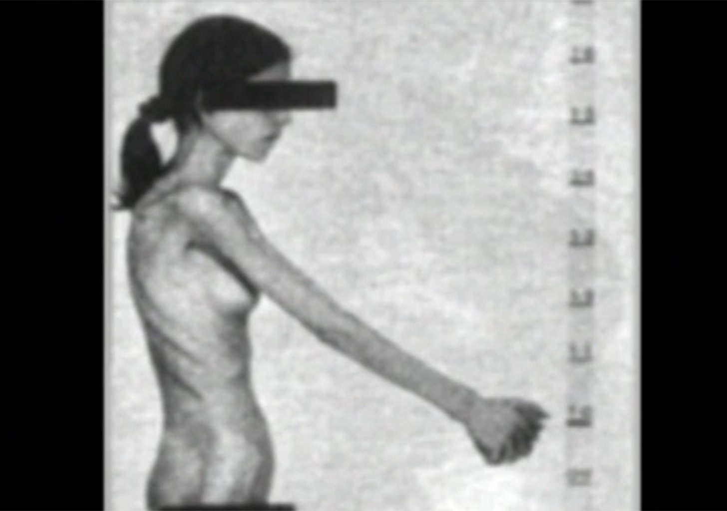 Im Würgegriff der Magersucht